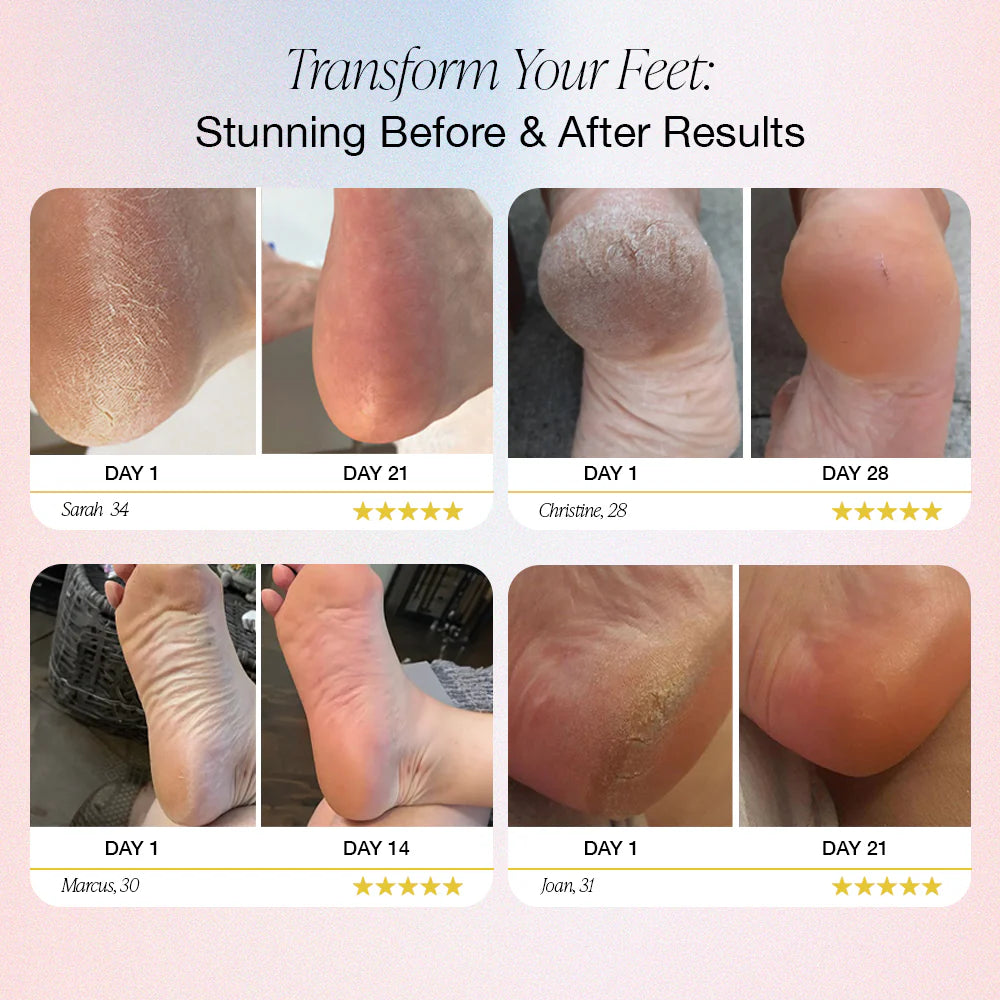 RIYAVO™ – ELECTRIC CALLUS REMOVER
