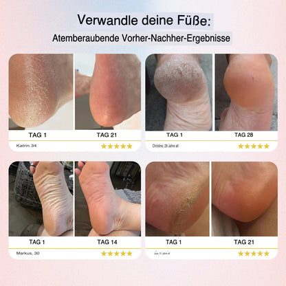 RIYAVO™ – FUSS-HORNHAUTENTFERNER